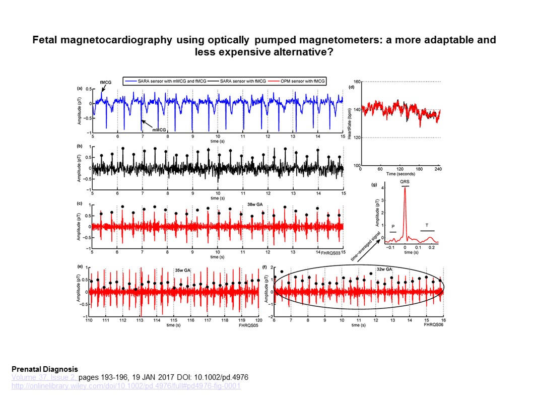 Simultaneous fetal MCG measurements with a SQUID system and QuSpin OPM sensors