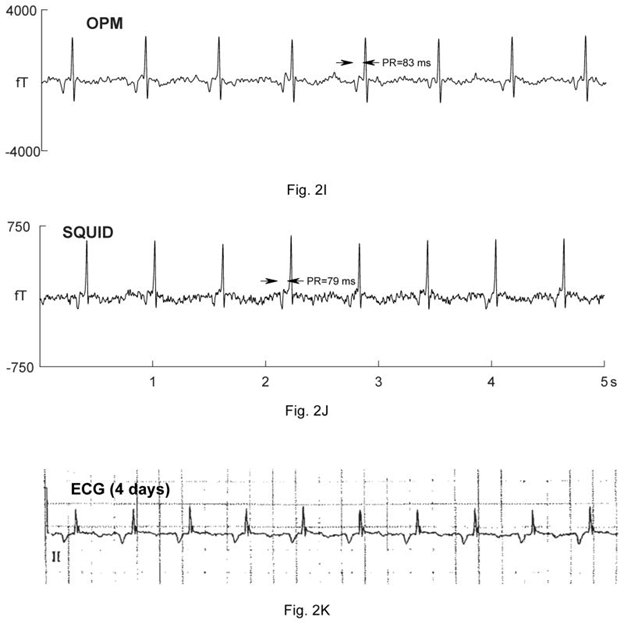 Data comparing processed output from the experimental OPM (QZFM) system and the Tristan SQUID system, with postnatal ECG data