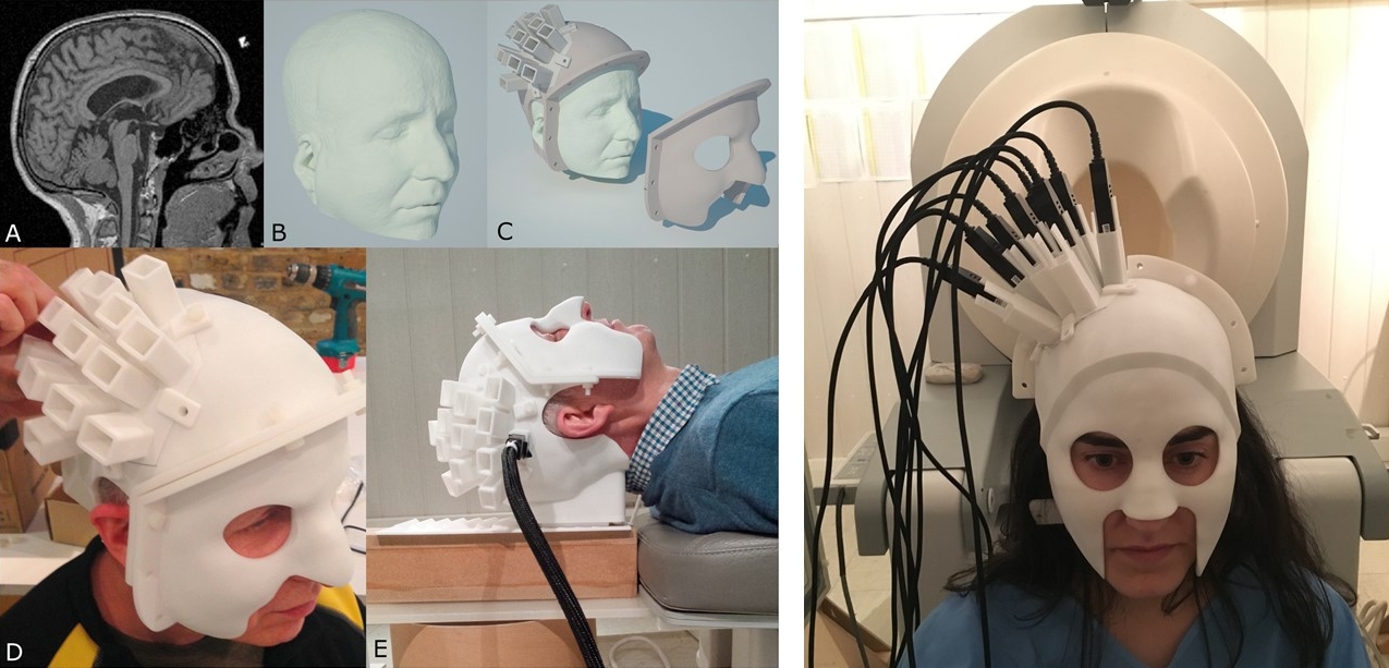 Custom 3D printed MEG helmet with slots for OPMs and a partial-head multi-sensor system